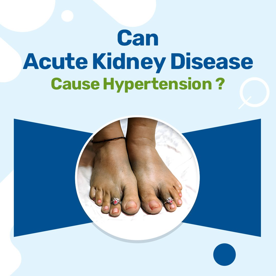 Can Acute Kidney Injury Cause Hypertension