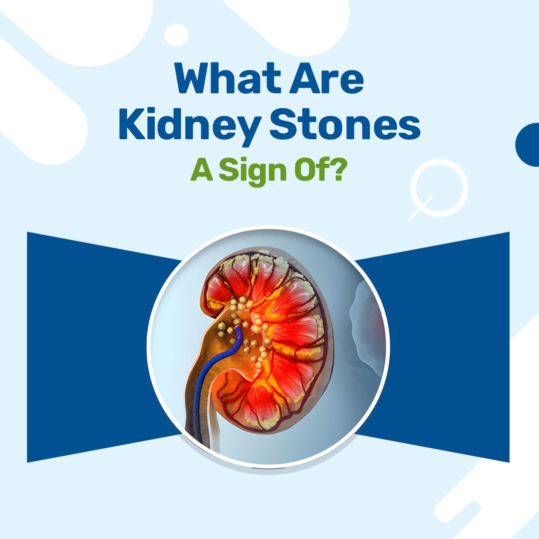 What Are Kidney Stones A Sign Of?