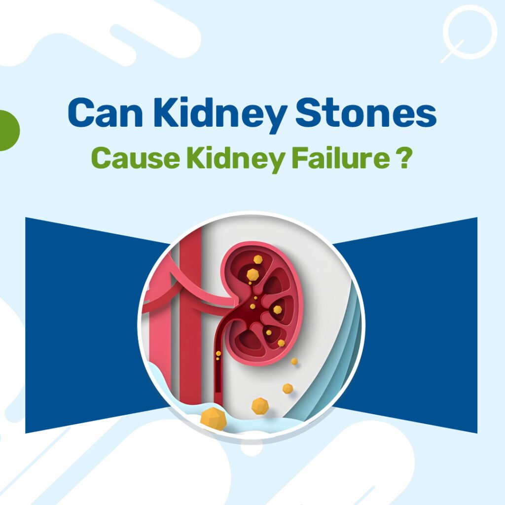 Can Kidney Stones Cause Kidney Failure
