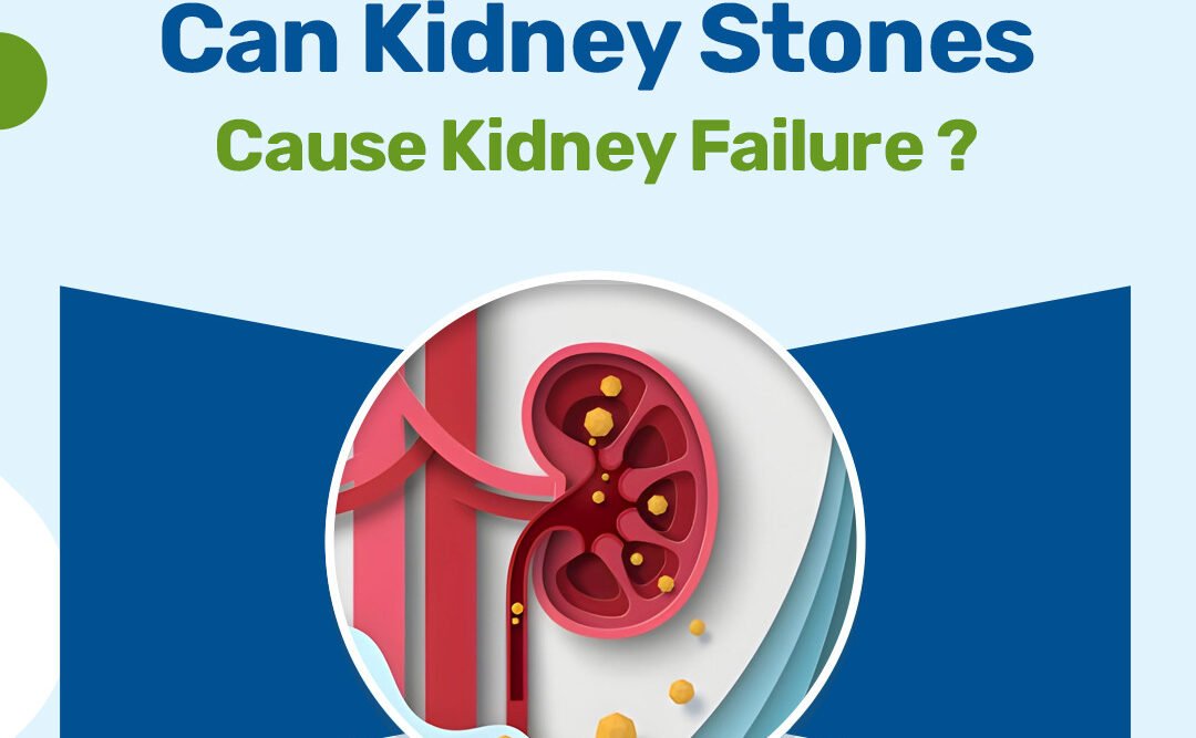Can Kidney Stones Cause Kidney Failure