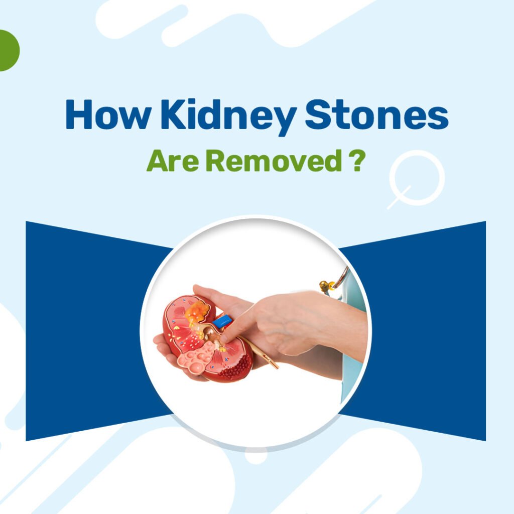 How Kidney Stones Are Removed