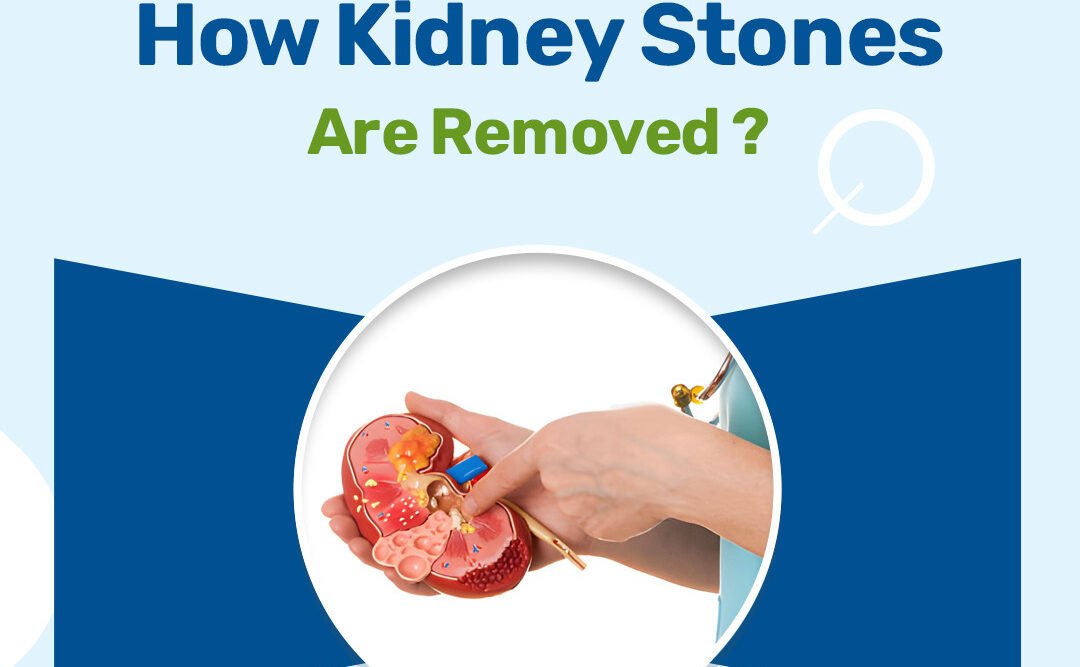 How Kidney Stones Are Removed