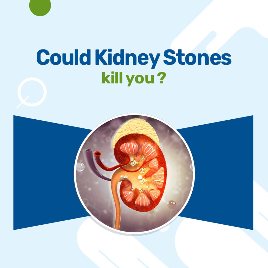 Could Kidney Stones Kill You
