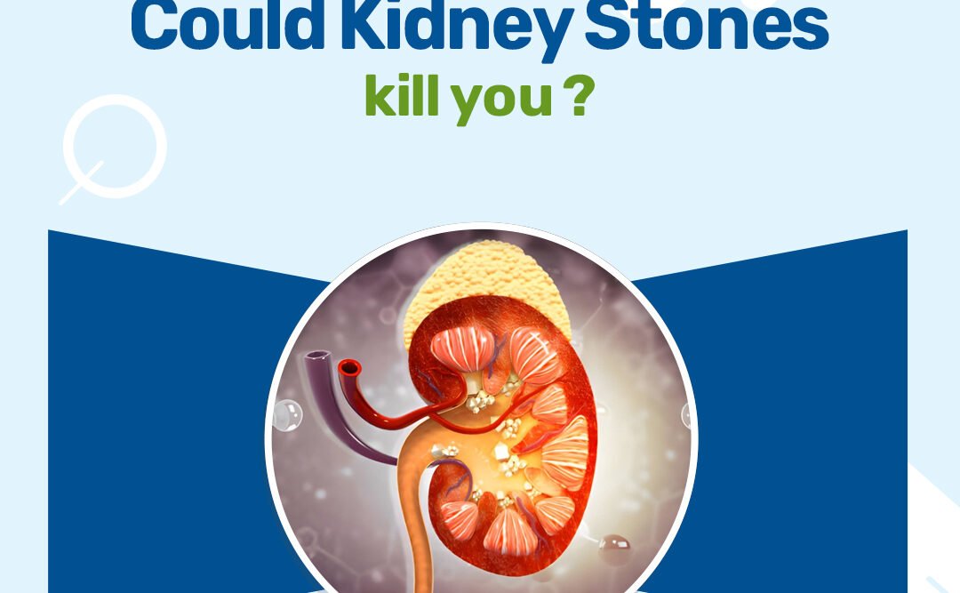 Could Kidney Stones Kill You