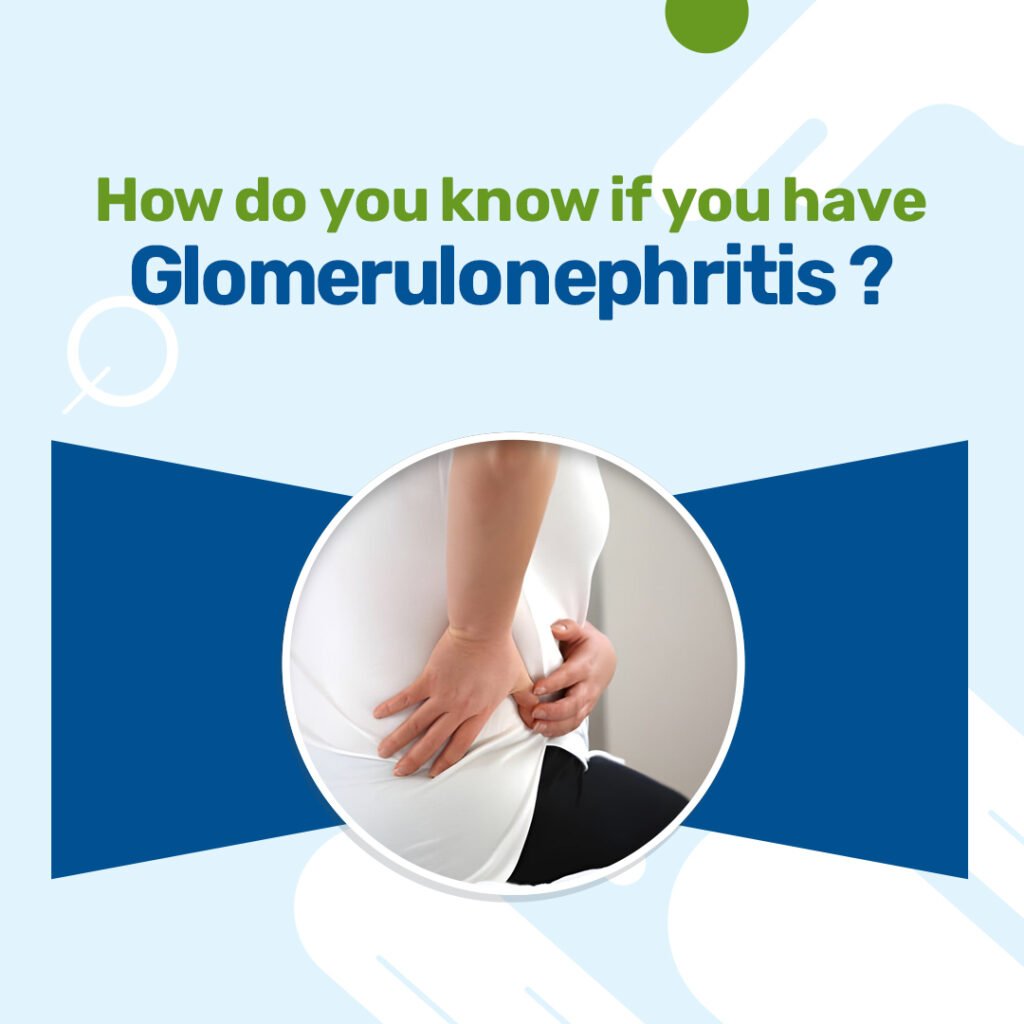 How Do You Know If You Have Glomerulonephritis