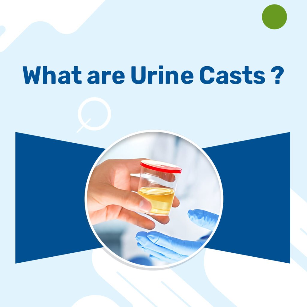 What are Urine Casts